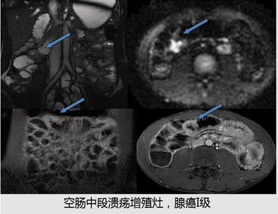 让小肠病变无处遁形 